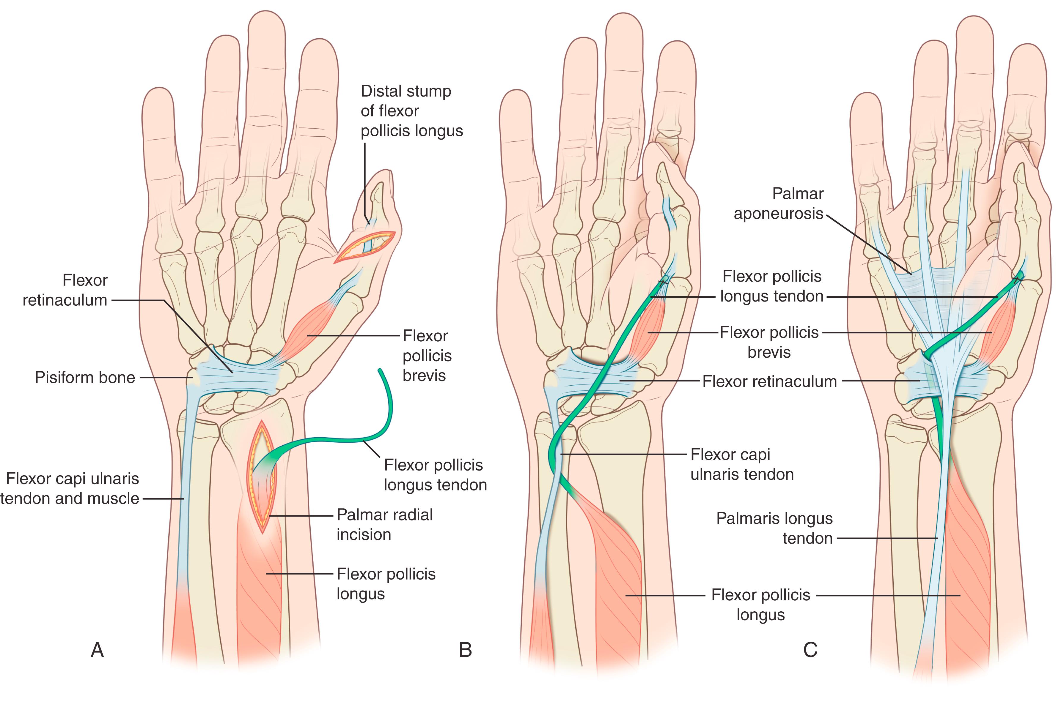 Fig. 31.9, A, Flexor pollicis longus (FPL) opponensplasty. Technique described by Mangus. A, The flexor pollicis longus tendon is exposed in the distal thumb and divided over the shaft of the proximal phalanx. The distal portion of the FPL is used to tenodese the phalangeal joint in 15 degrees flexion. The proximal portion of the tendon is brought out of a wound on the palmar-radial aspect of the distal forearm. B, The FPL is then passed ulnarly in the plane between the FDP and FDS tendons and around the flexor carpi ulnaris tendon. It is then passed through a wide subcutaneous tunnel into a wound on the radial aspect of the thumb MCP joint where it is attached to the distal tendon of the superficial head of the flexor pollicis brevis (or alternatively the distal tendon of abductor pollicis brevis). C, Alternative technique of FPL opponensplasty recommended by Burkhalter (described in previous editions of this book). The FPL is divided at its insertion onto the distal phalanx of the thumb and passed proximally into an incision on the palmar-radial aspect of the distal forearm. It is then passed in the plane between the FDP and FDS tendons through the carpal tunnel into an incision just radial to the thenar eminence at the base of the palm, in the line of the ulnar border of the ring finger. The tendon is then passed upward, just distal to the flexor retinaculum and ulnar to the palmar aponeurosis. It is then passed through a wide subcutaneous tunnel to the dorsoradial aspect of the thumb MCP joint where it is joined to the superficial head of the flexor pollicis brevis tendon. The interphalangeal joint is fused. The current author is uncertain whether an FPL tenodesis would be possible with this technique as he wonders if the tendon transfer might be too short if the distal 1 to 2 cm of the FPL tendon is retained on its insertion on the distal phalanx to tenodese the IP joint.