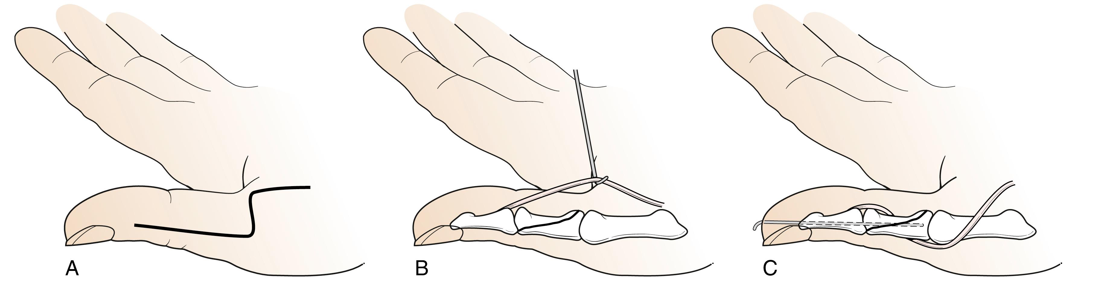 Fig. 31.10, Makin’s flexor pollicis longus (FPL) opponensplasty. A, A bayonet incision is made on the radial aspect of the thumb. The radial neurovascular bundle is protected, and the proximal phalanx is exposed by subperiosteal dissection around its circumference. The flexor sheath is released throughout its length to allow retraction of the FPL tendon. B, An oblique osteotomy is made in the proximal phalanx and the FPL tendon is passed through this so that distally it passes around the ulnar border of this bone. It then runs over the extensor surface of the metacarpophalangeal joint before passing radially over the neck of the metacarpal. C, The osteotomy is then stabilized with a longitudinal Kirschner wire (or interfragmentary screws) until union.