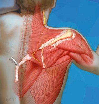 FIG. 37.4, Reflected lower trapezius demonstrating relationship to underlying spinal accessory nerve.