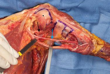 FIG. 37.5, Insertion of subscapularis ( filled dot ), latissimus dorsi ( open square ), and teres major ( open triangle ) on the anterior humerus.