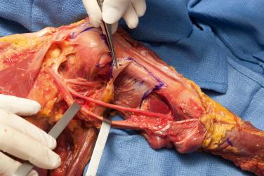 FIG. 37.6, Anatomic dissection showing that though the teres major tendon ( open triangle ) appears to be inserted distal to the latissimus dorsi tendon ( open square ), the width of its insertion extends over a longer distance, deep to the latissimus dorsi tendon and overlapping most of the length of the insertion of that tendon.