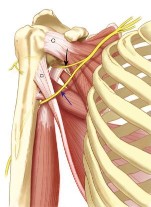 FIG. 37.7, Diagram of relationship between axillary ( black arrow ), radial ( blue arrow ), and insertions of subscapularis ( open circle ), latissimus dorsi ( open square ), and teres major (open triangle ).