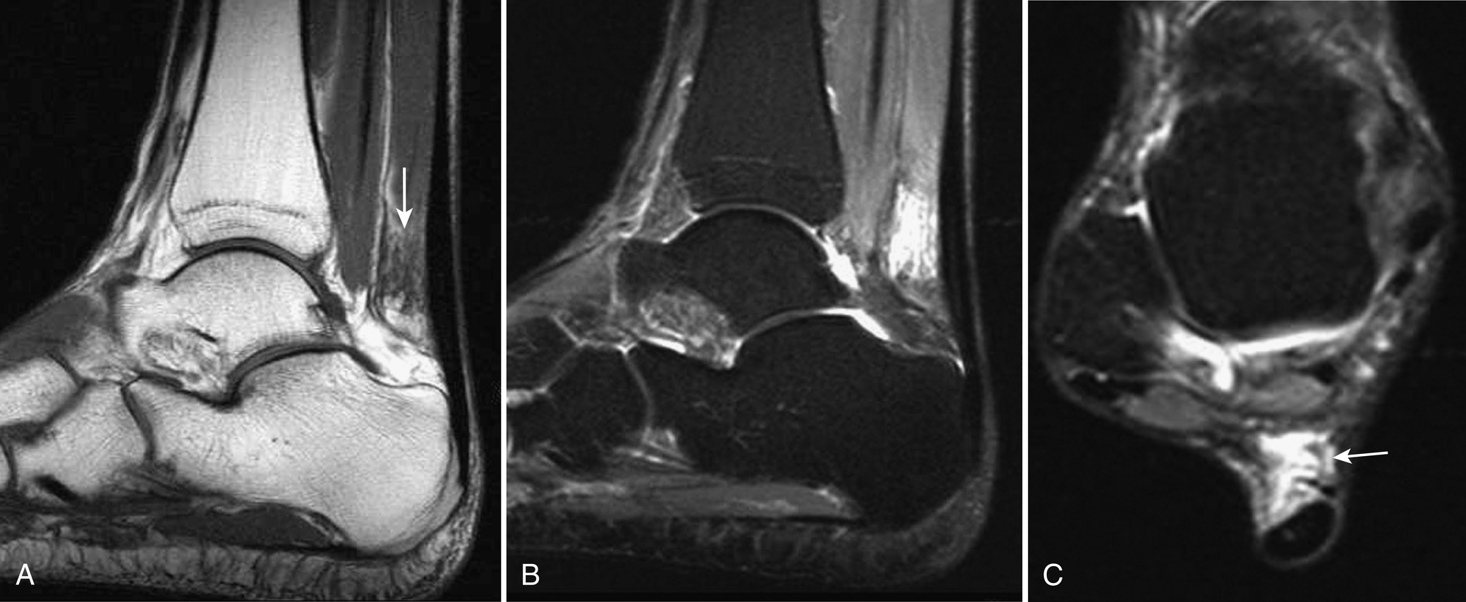 Fig. 3.7, Paratendinitis.