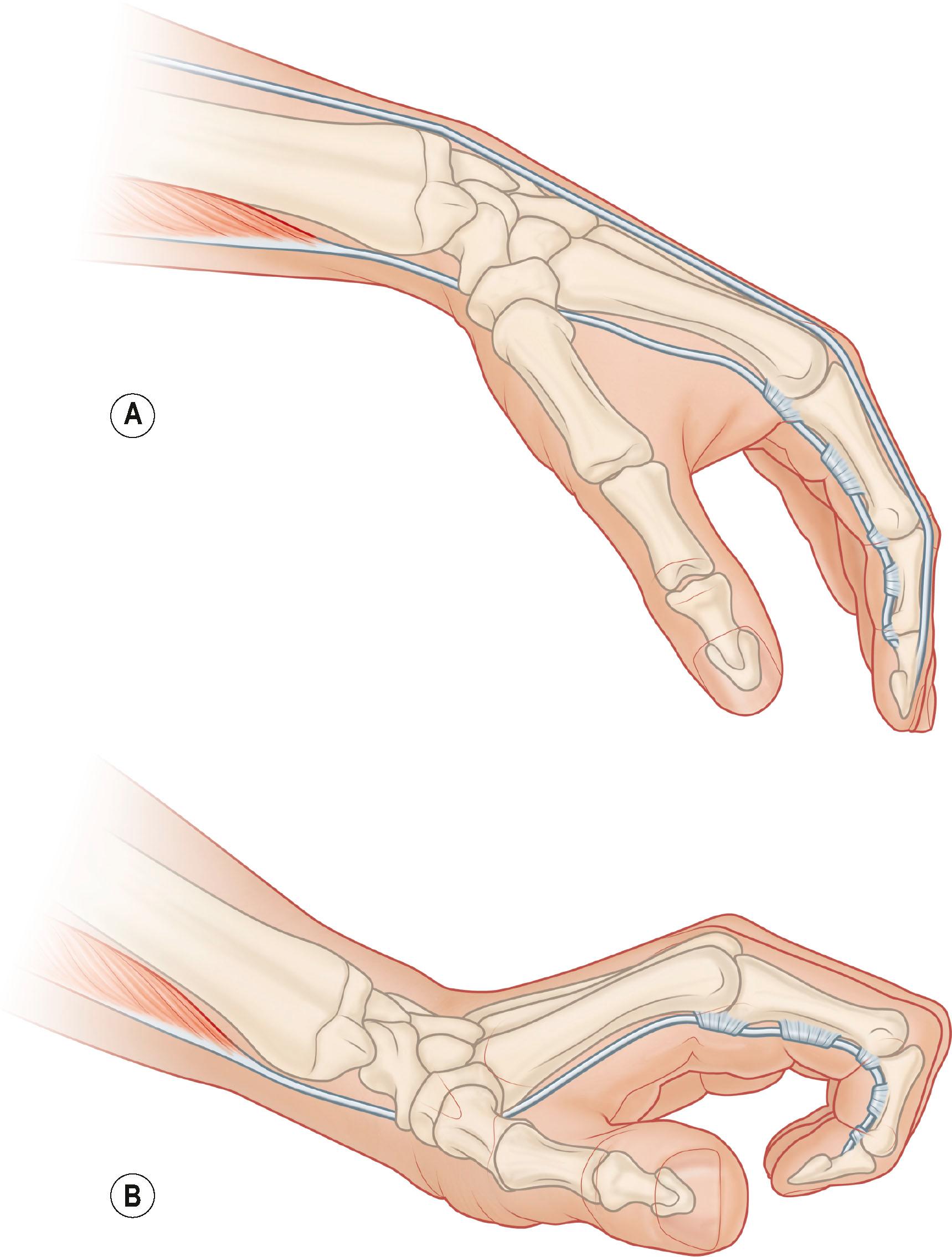 Figure 25.1, (A) The wrist tenodesis effect: wrist flexion will increase the potential amplitude of a tendon transfer to restore finger extension by 20 mm. (B) Similarly, wrist extension will increase the potential amplitude of a tendon transfer to restore finger flexion by 20 mm.