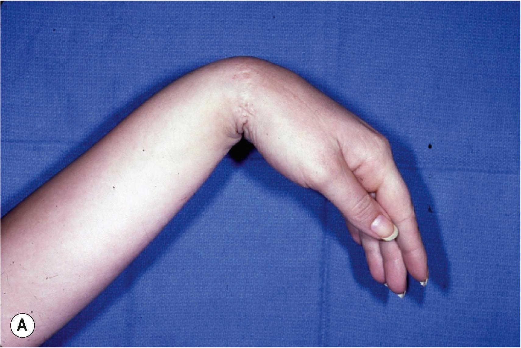 Figure 25.2, (A) Typical appearance of a patient with radial nerve palsy with wrist drop. The fingers extend at the proximal interphalangeal joints through the tenodesis effect. (B) Even with the wrist supported in extension, the patient is unable to actively extend the fingers at the metacarpophalangeal joints or extend the thumb.