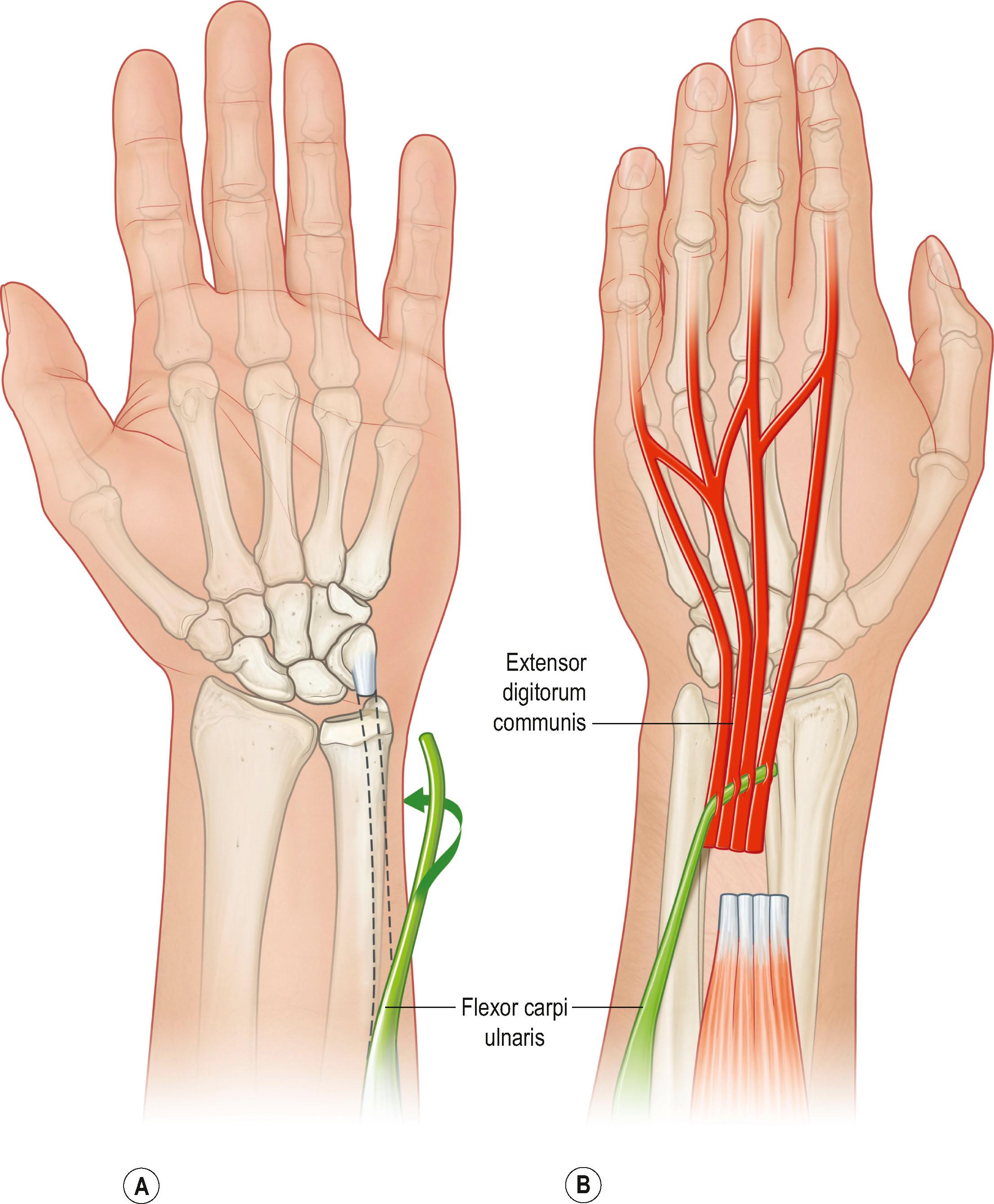 Figure 25.4, (A) The flexor carpi ulnaris tendon is transected and passed around the ulnar border of the distal forearm and (B) woven into the combined extensor digitorum communis tendons proximal to the extensor retinaculum.