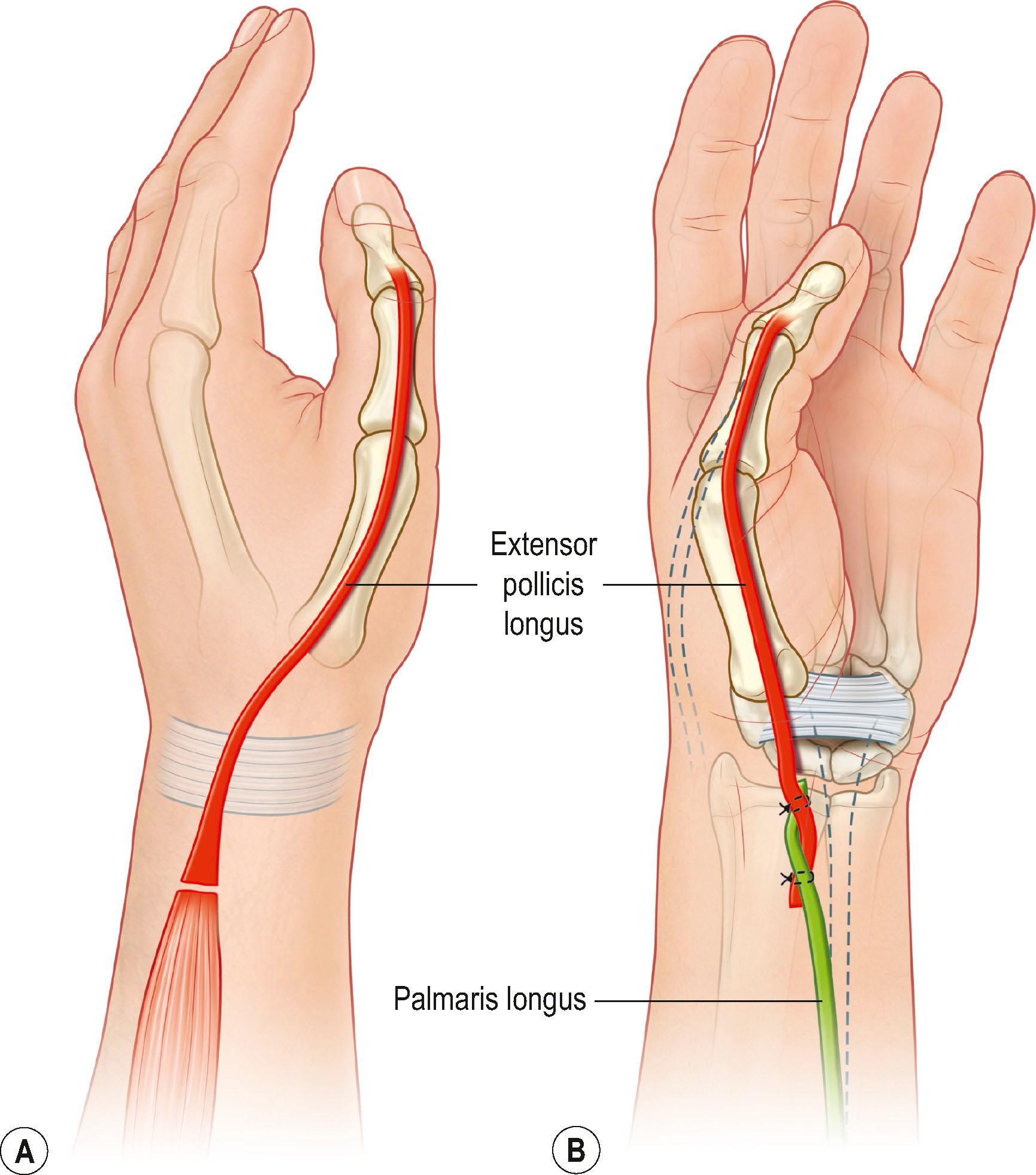 Figure 25.5, (A) The extensor pollicis longus tendon is transected at its musculotendinous junction, (B) re-routed into the anterior incision in the distal forearm and attached to the palmaris longus, if present, to provide both thumb extension and some radial abduction.