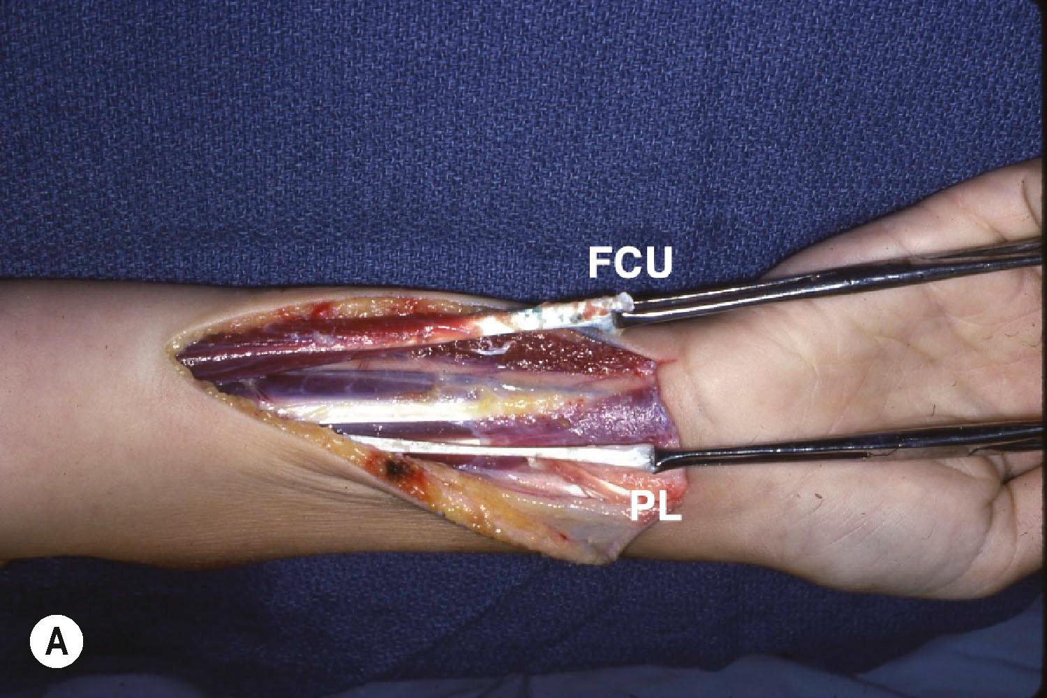 Figure 25.6, (A) Through a volar incision in the distal third of the forearm, the flexor carpi ulnaris (FCU) tendon and its distal muscle and the palmaris longus (PL) tendon are isolated. (B) The pronator teres (PT) tendon is passed around the radial border of the forearm and sutured to extensor carpi radialis brevis (ECRB). The FCU tendon is passed around the ulnar border of the distal forearm and sutured to the extensor digitorum communis (EDC) tendons.
