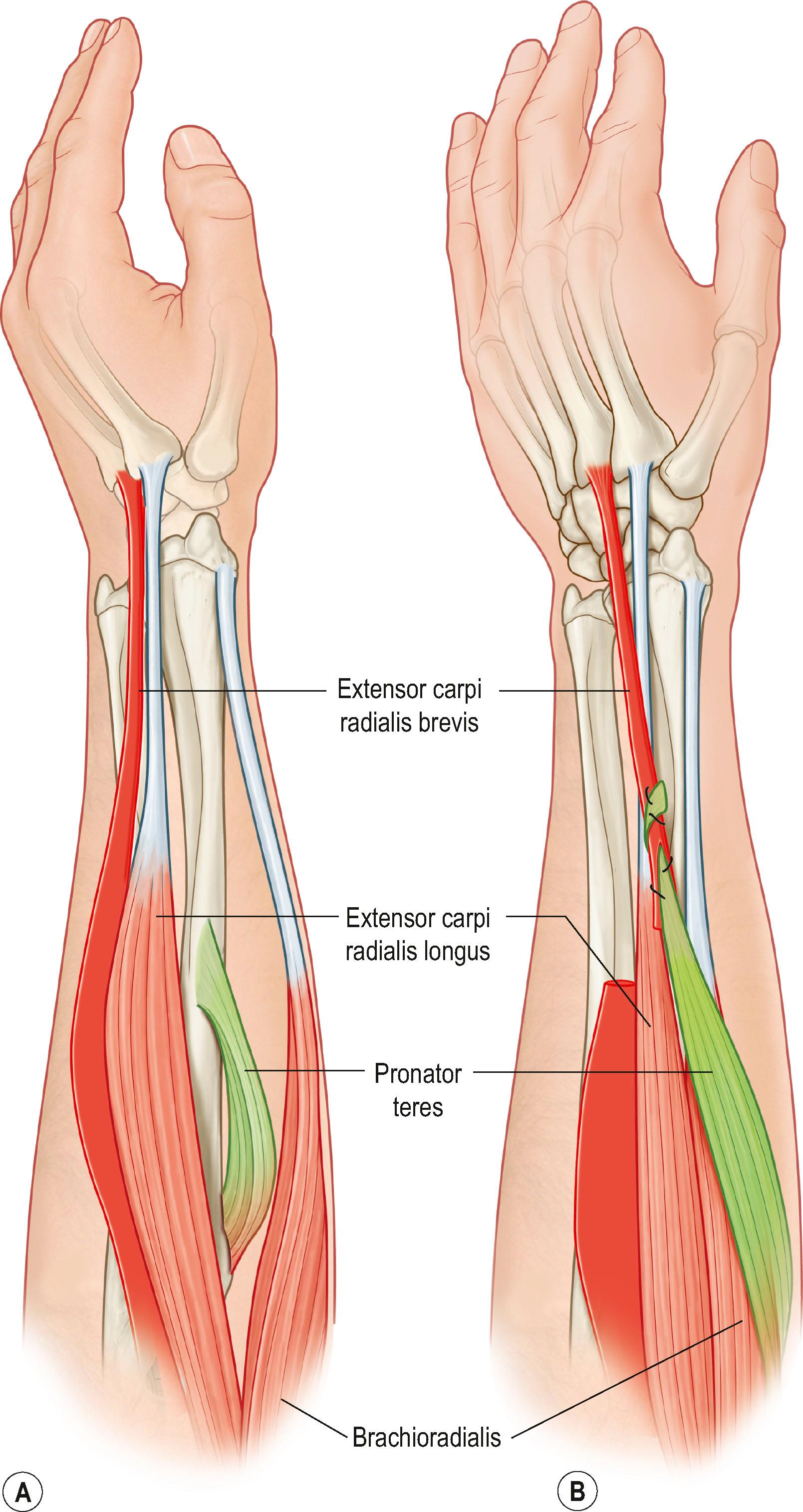 Figure 25.3, (A) The tendon of insertion of pronator teres is released from the radius. (B) The pronator teres is passed around the radial border of the forearm superficial to brachioradialis and sutured to the transected tendon of extensor carpi radialis brevis.