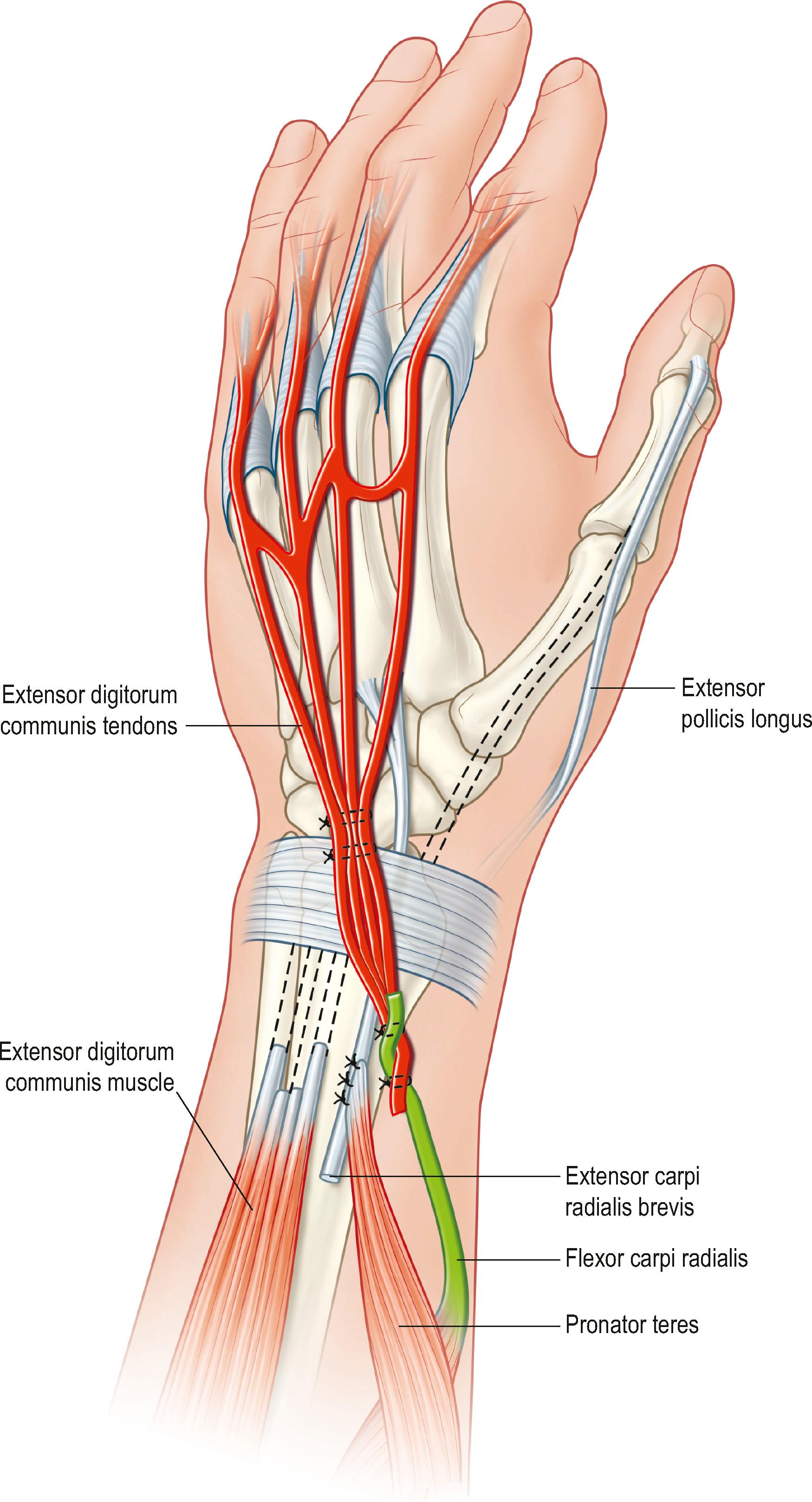 Figure 25.8, Flexor carpi radialis transfer to the combined tendons of extensor digitorum communis. The tendon juncture may have to lie superficial to the extensor retinaculum. Tendon transfers of pronator teres to extensor carpi radialis brevis and palmaris longus to extensor pollicis longus are the same as in the flexor carpi ulnaris transfers.