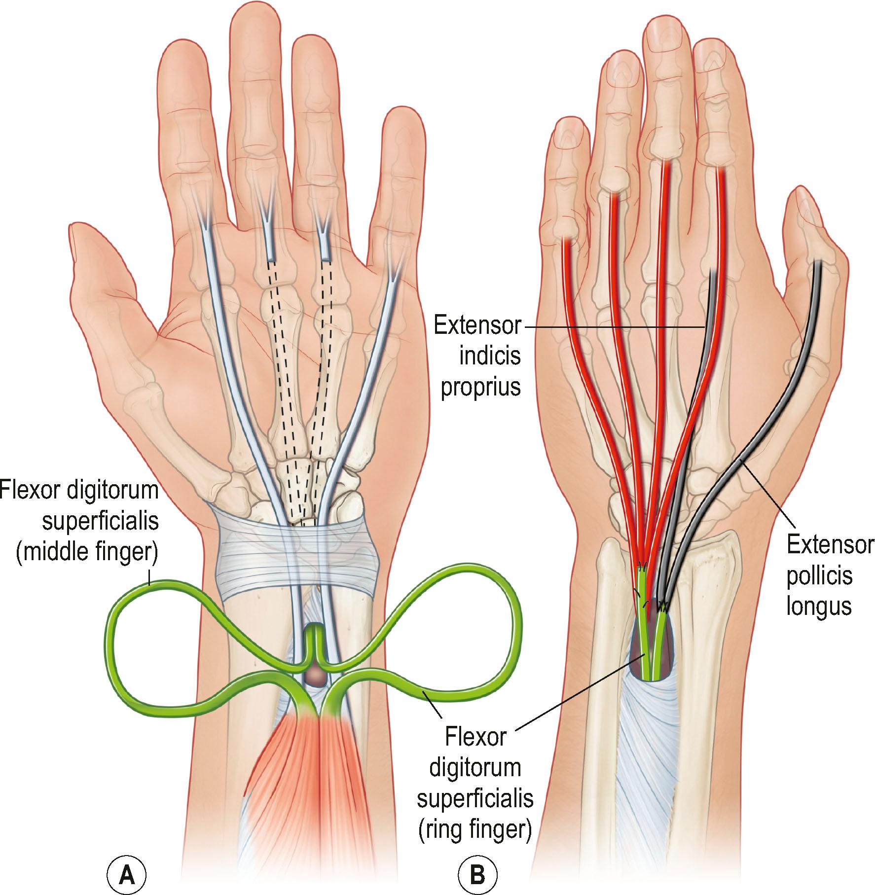 Figure 25.9, (A) In the Boyes tendon transfer, the long and ring finger flexor digitorum superficialis tendons, FDS L and FDS R , are transferred either through a window in the interosseous membrane or around the radial and ulnar border of the forearm (B) to restore extension of the extensor digitorum communis tendons to the long, ring, and small fingers and the extensor indicis proprius and extensor pollicis longus tendons.