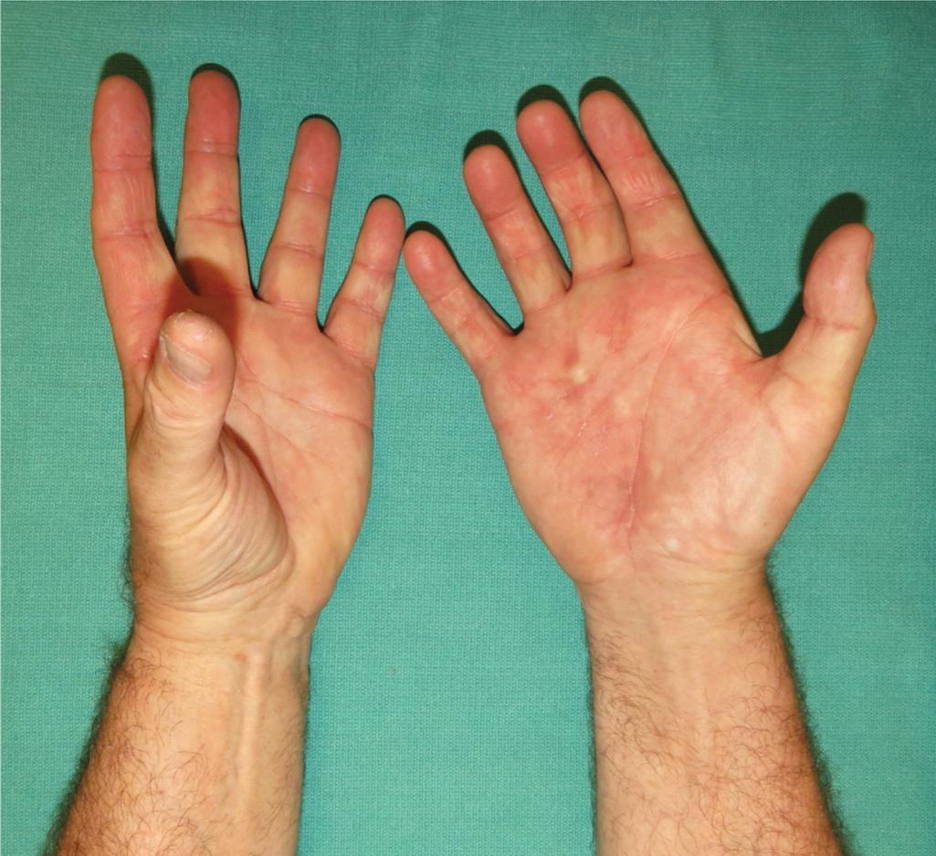 FIGURE 67.2, The injured left hand has no ability to oppose the thumb. The right hand is normal.