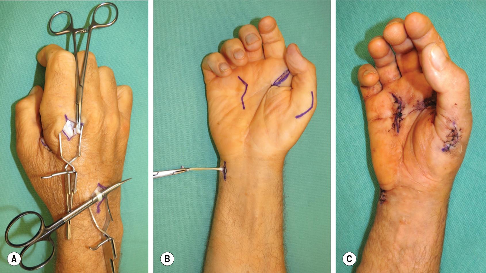 FIGURE 67.3, Patient from Fig. 67.1 and 67.2 after treatment with EIP-to-APB opponensplasty, first webspace deepening, and FDS lasso to the ring and small fingers. The EIP tendon is harvested (A), passed around the ulna (B), and tensioned to the APB (C). APB , Abductor pollicis brevis; EIP , extensor indicis proprius; FDS , flexor digitorum superficialis.