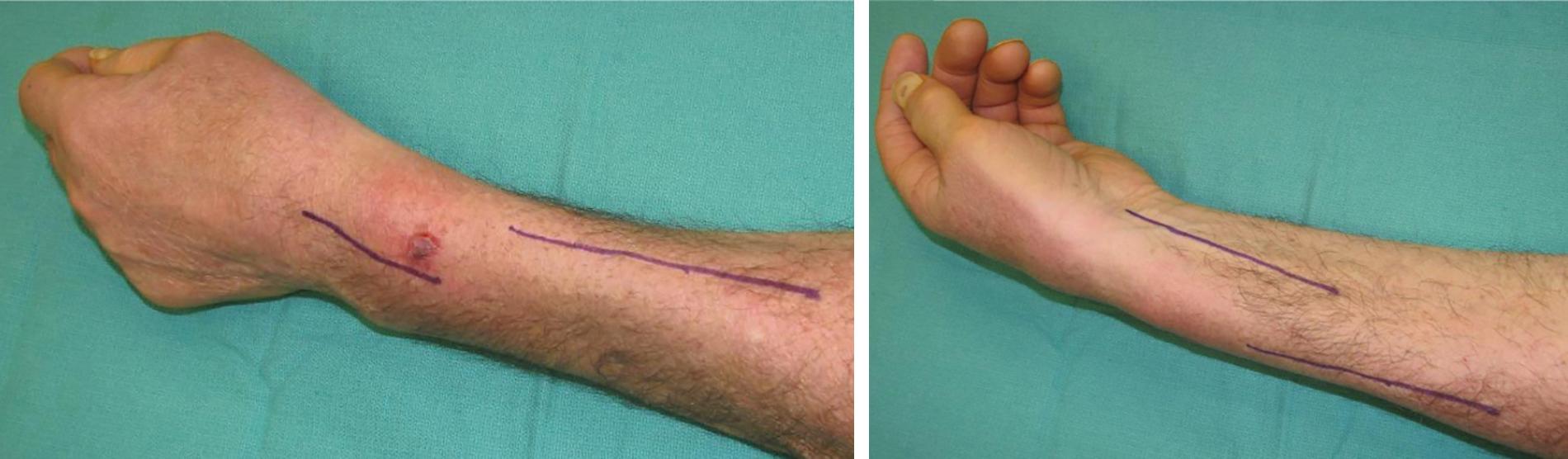 FIGURE 66.1, Incision design for PT-to-ECRB, FCR-to-EDC, and PL-to-EPL transfers. ECRB , Extensor carpi radialis brevis; EDS , extensor digitorum superficialis; EPL , extensor pollicis longus; FCR , flexor carpi radialis; PL , palmaris longus; PT , pronator teres.