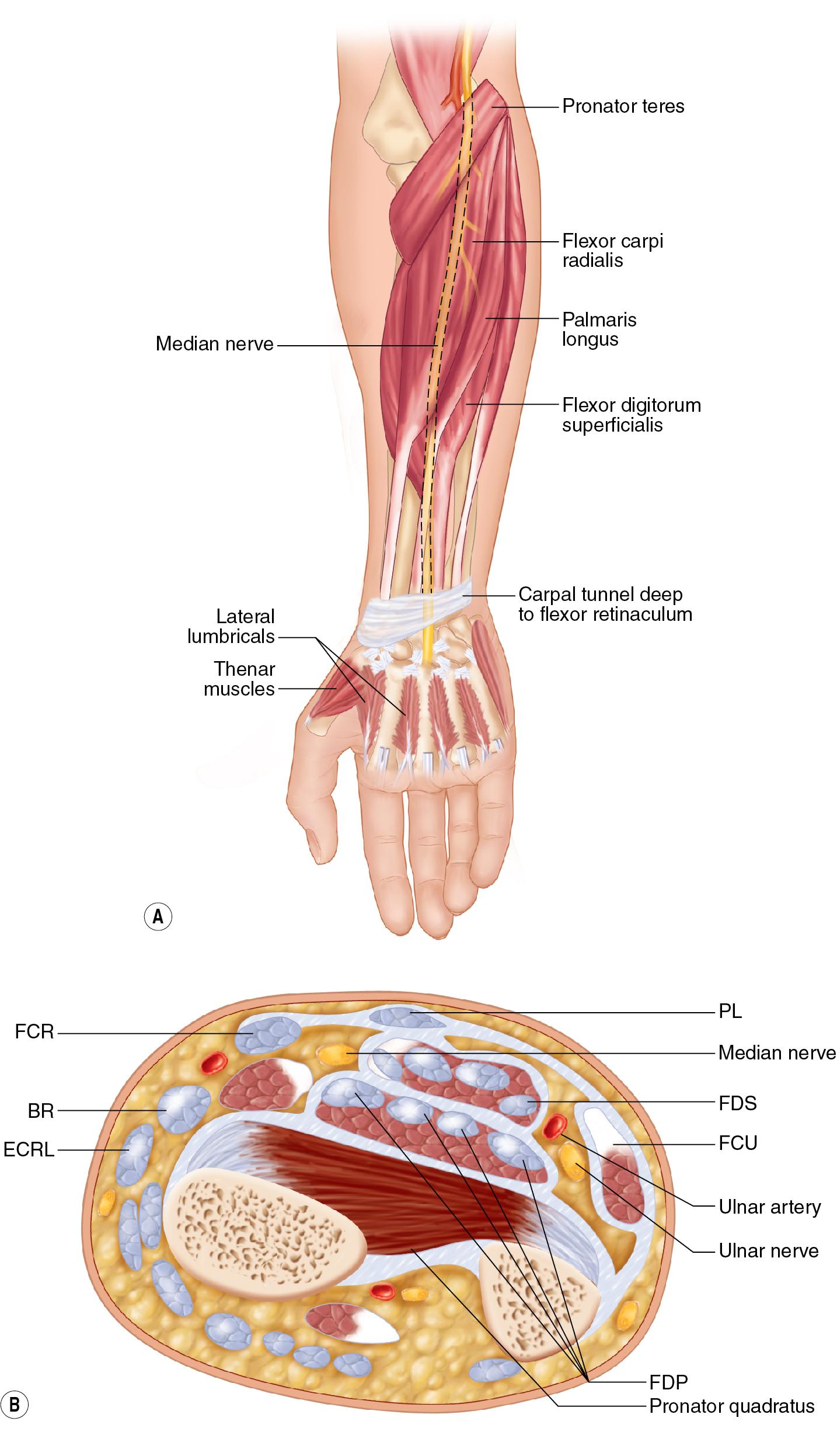 FIGURE 64.1, Patients with high median nerve injuries suffer denervation of the abductor pollicis brevis (APB), the opponens pollicis, the superficial (radial) head of the flexor pollicis brevis (FPB), the radial two lumbricals, the flexor pollicis longus (FPL), the index and long finger flexor digitorum profundus (FDP), the flexor digitorum superficialis (FDS) to all fingers, the flexor-pronator group (pronator teres, flexor carpi radialis [FCR]), the palmaris longus (PL), and the pronator quadratus (PQ).