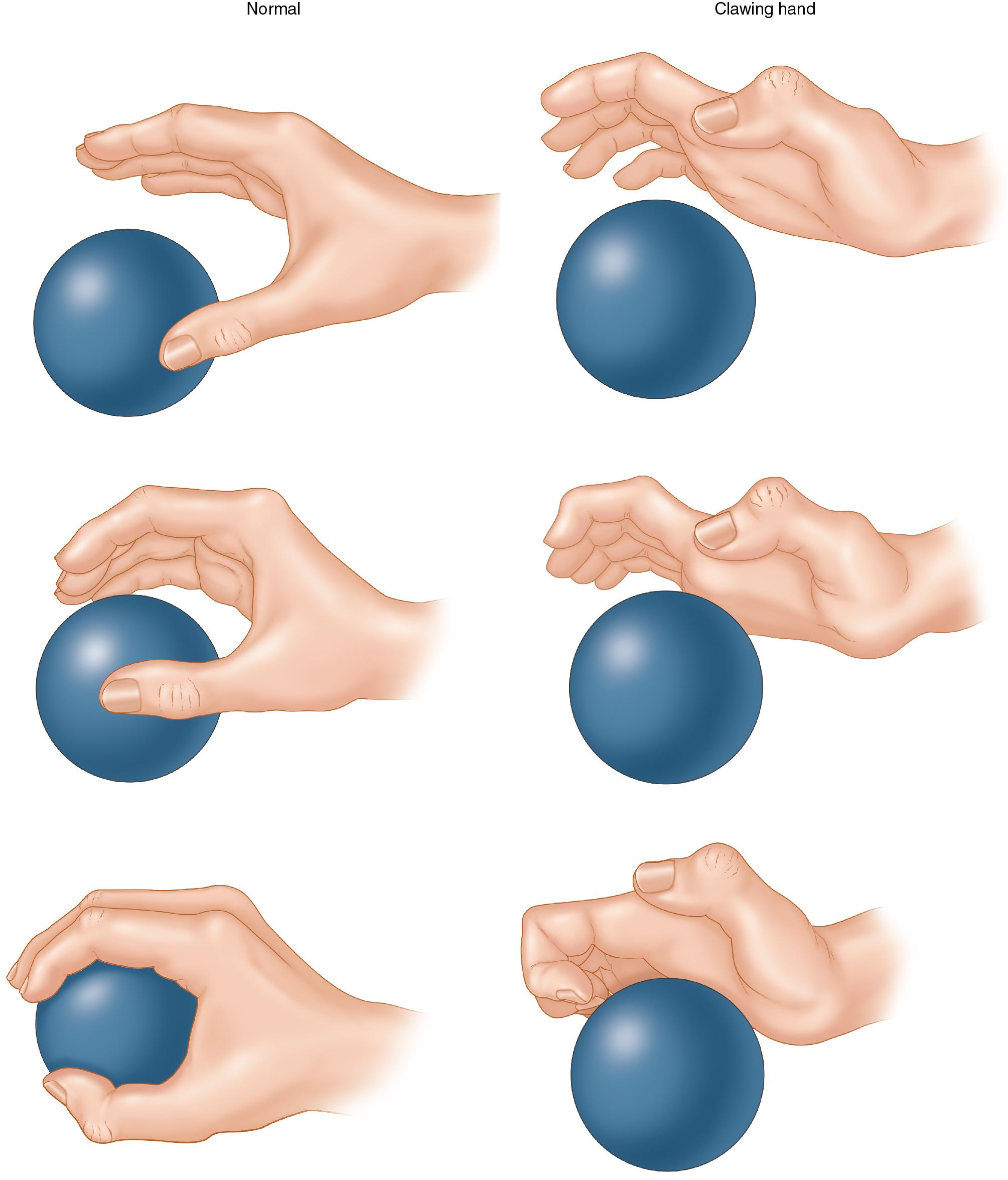 FIGURE 65.1, Clawing deformities impair the ability to grip objects.