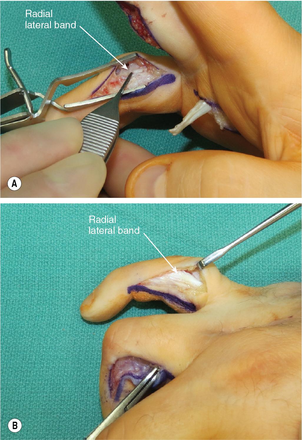 FIGURE 65.11, Exposure of the radial lateral bands of the ring (A) and small (B) fingers.