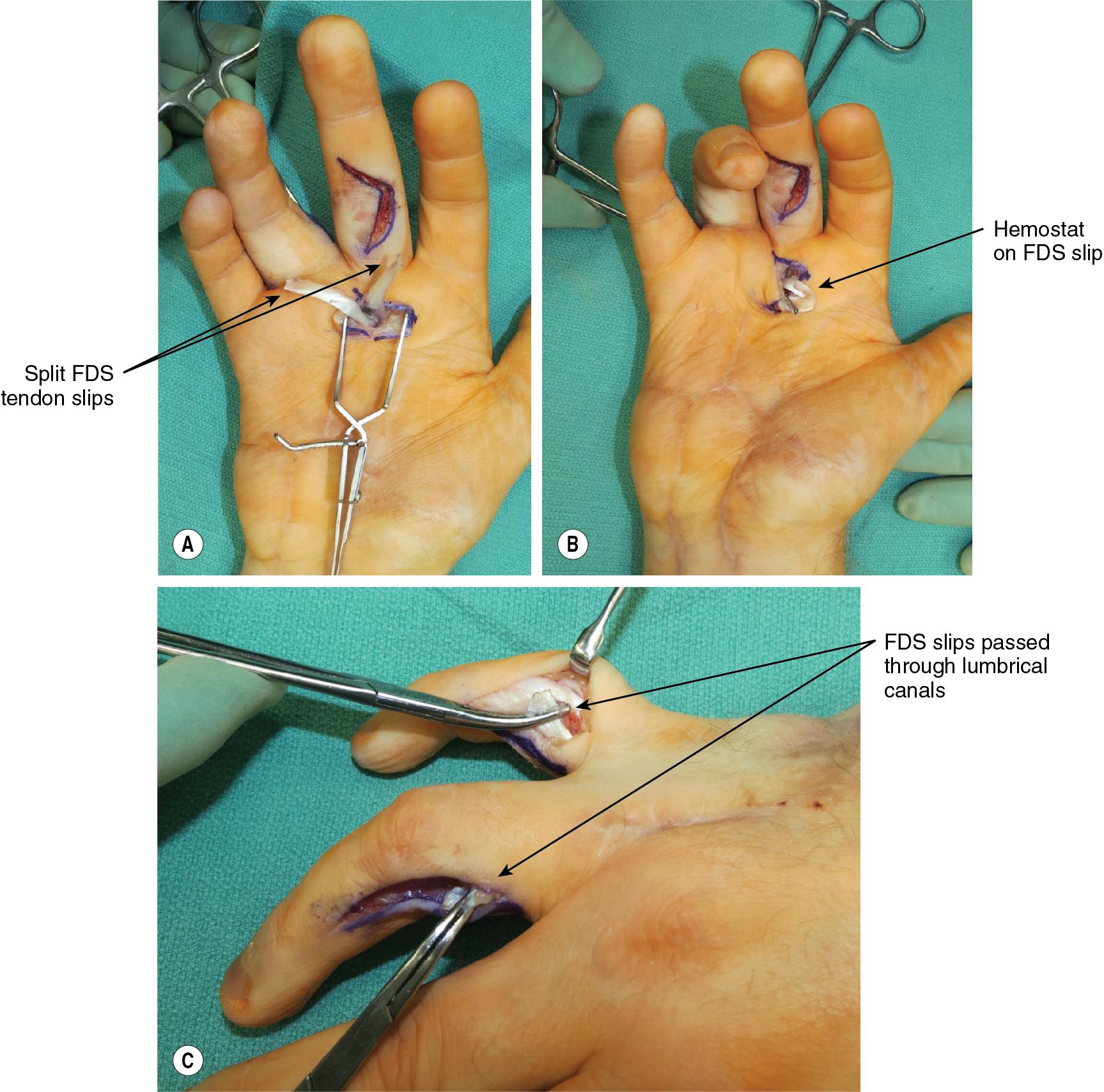 FIGURE 65.12, A hemostat is used to create a tunnel from the radial lateral band to the harvested flexor digitorum superficialis (FDS) tendon for both the ring (A) and small (B) fingers, and the tendon is passed (C).