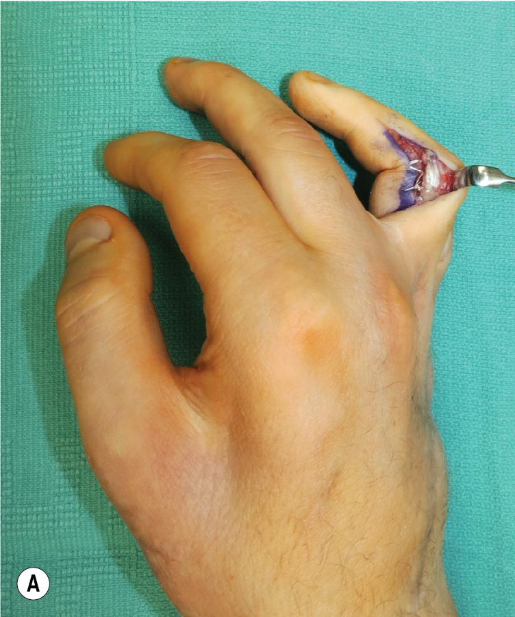 FIGURE 65.13, (A) The transferred tendon is secured to the radial lateral band with 4-0 Ethibond sutures. (B) The flexor digitorum superficialis (FDS) tendon should be deep to the transverse metacarpal ligament.
