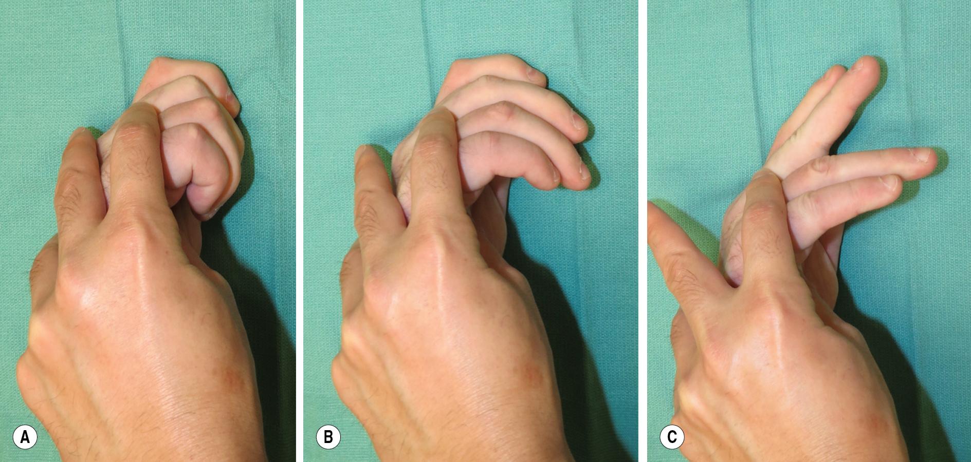 FIGURE 65.2, (A) One performs the Bouvier test by keeping the metacarpophalangeal (MCP) joints flexed when the patient extends the interphalangeal (IP) joints. (B) The inability to extend the IP joints with the MCP joints flexed is a negative test; (C) Active extension signifies a positive test.