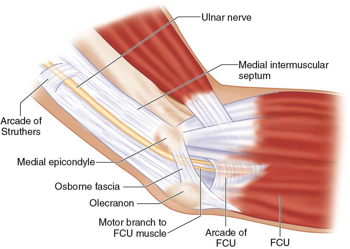 FIGURE 65.3, Relevant anatomy around the ulnar nerve at the elbow. FCU, Flexor carpi ulnaris.