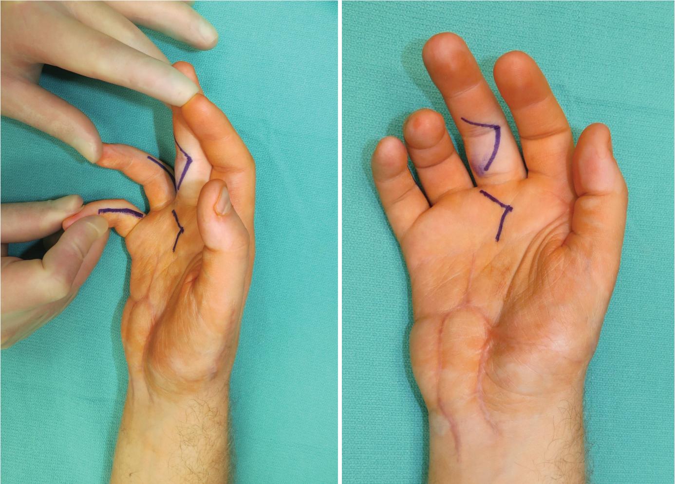 FIGURE 65.5, Incisions to correct ring and small finger claw deformities with flexor digitorum superficialis (FDS) transfer.