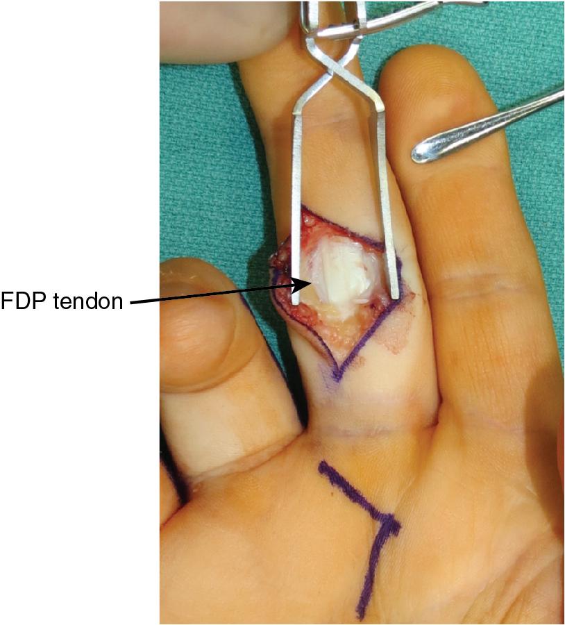 FIGURE 65.6, Exposure of the flexor tendons after opening the A3 pulley.