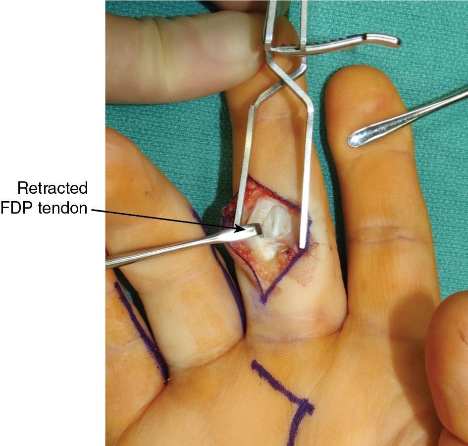 FIGURE 65.7, Retraction of the flexor digitorum profundus (FDP) tendon reveals the underlying flexor digitorum superficialis (FDS) tendon.