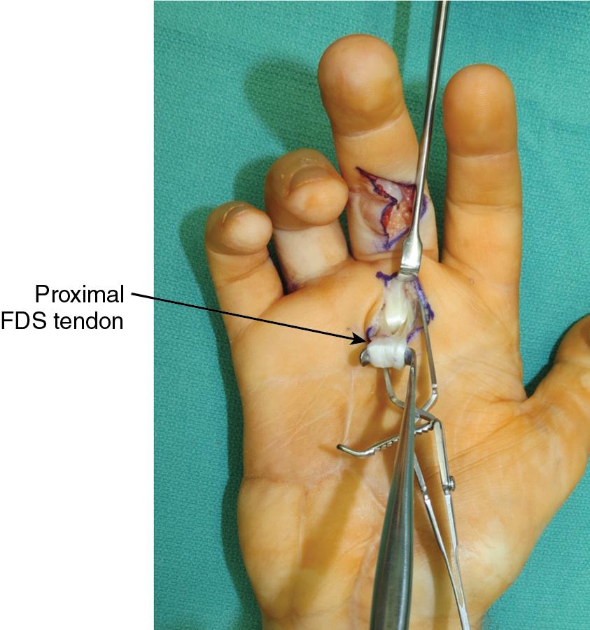 FIGURE 65.9, Deliver the transected flexor digitorum superficialis (FDS) tendon through the proximal incision.