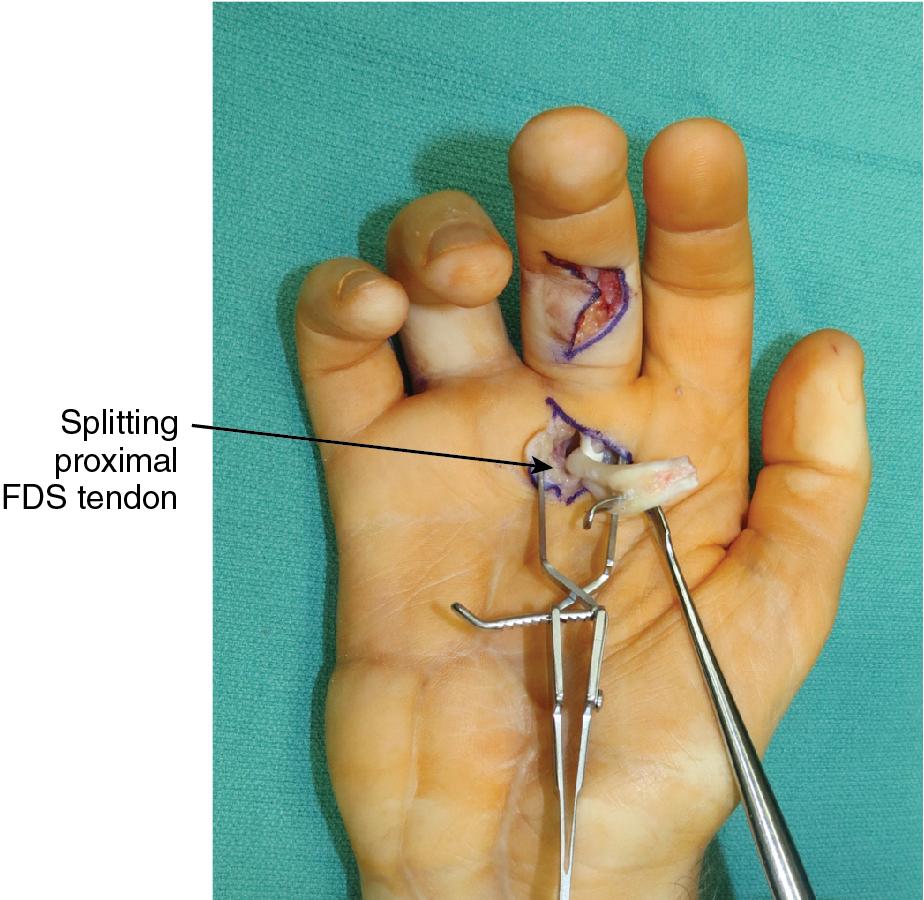 FIGURE 65.10, The flexor digitorum superficialis (FDS) tendon is split to create limbs for the ring and small fingers.