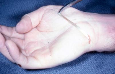 Figure 26.11, The palmar incision and the direction of the extensor indicis proprius (EIP) transfer across the palm.