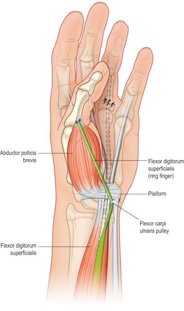 Figure 26.13, The flexor digitorum superficialis (FDS) to abductor pollicis brevis (APB) transfer to restore thumb opposition is depicted schematically.