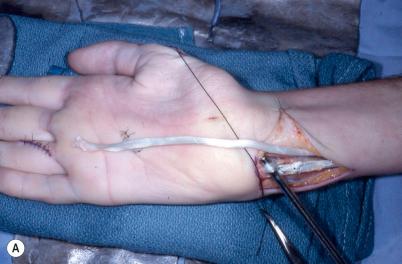 Figure 26.14, (A) Incisions used to transfer the ring finger flexor digitorum superficialis (FDS) tendon. (B,C) The technique of using one-half of the flexor carpi ulnaris (FCU) sutured to itself as a pulley is demonstrated.