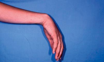 Figure 26.2, The typical posture of the hand and wrist of a patient with a high radial nerve palsy. The wrist cannot be extended. The fingers are extended through the tenodesis effect.