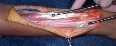 Figure 26.4, A dorsal incision exposes the wrist and finger extensors. The flexor carpi ulnaris (FCU) tendon has been brought from palmar to dorsal, around the ulnar border of the forearm.