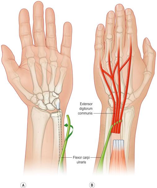 Figure 26.6, The flexor carpi ulnaris (FCU) is brought around the ulnar border of the forearm (A,B) and woven into the combined tendons of the extensor digitorum communis (EDC).