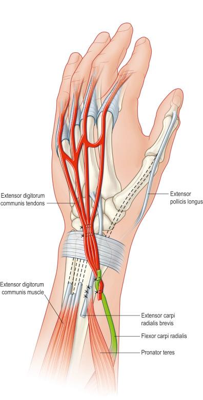 Figure 26.8, Transfer of the flexor carpi radialis (FCR) to the combined tendons of the extensor digitorum communis (EDC).