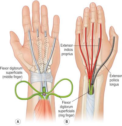 Figure 26.9, Transfer of the long and ring finger superficialis tendons (FDS L , FDS R ) through a window in the interosseous membrane (A) to restore function to the extensor digitorum communis (EDC) tendons and extensor indicis proprius (EIP) and extensor pollicis longus (EPL) (B) .