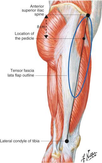 Figure 60.3, Anatomic landmarks for the TFL flap.