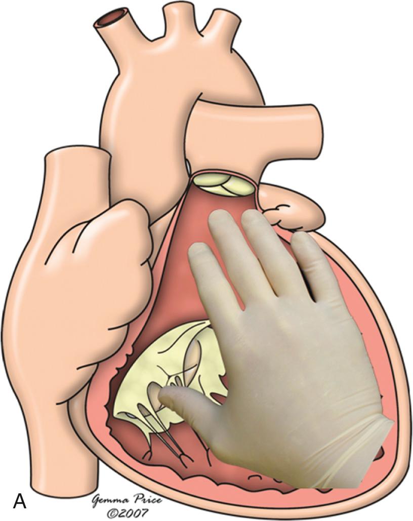 Fig. 1.5, Diagram showing how the palmar surface of the right hand can be placed on the septal surface of the normal morphologically right ventricle with the thumb in the inlet component and the fingers extending into the ventricular outlet. (A) The essence of right hand ventricular topology, also known as a d-ventricular loop. The palmar surface of the left hand fits in comparable fashion within the morphologically left ventricle, but the right hand is taken as the arbiter for the purposes of categorization. (B) The mirror-imaged normal heart. In this setting, the palmar surface of the left hand can be placed on the septal surface of the morphologically right ventricle with the thumb in the inlet and the fingers in the outlet.