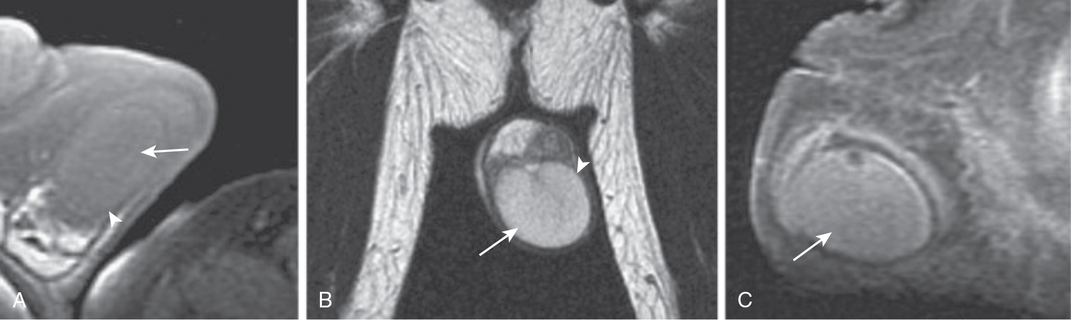 Fig. 30.2, Normal testis on magnetic resonance imaging. The normal testis appears homogeneous and isointense to muscle on T1-weighted image ( A: arrow ), with the tunica albuginea appearing hypointense ( A: arrowhead ); hyperintense on T2-weighted image ( B: arrow), with the tunica albuginea hypointense ( B: arrowhead ); and homogeneously enhancement after administration of gadolinium ( C: arrow ).