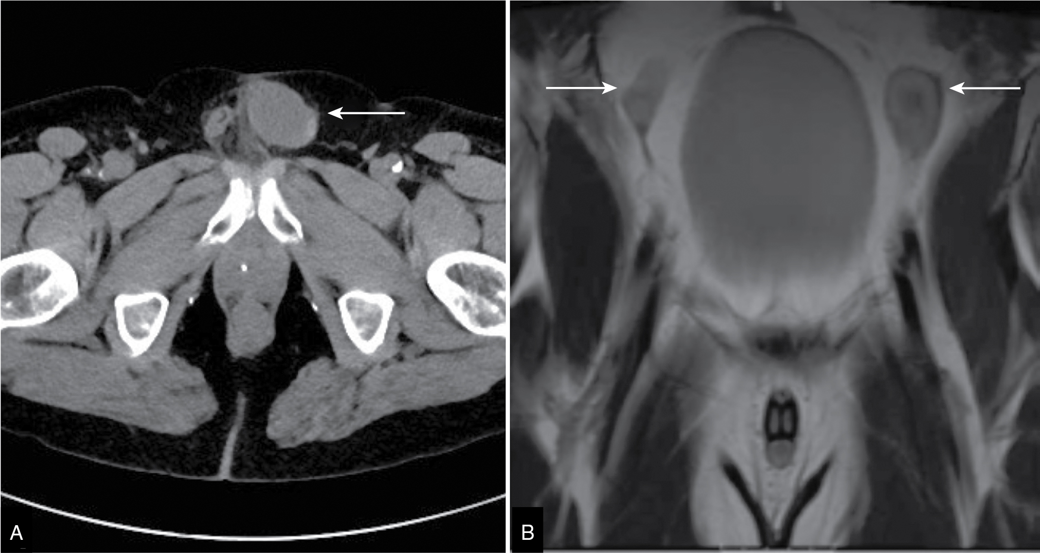Fig. 30.3, Cryptorchidism. Axial computed tomography reveals the left testis of a 53-year-old male centered within the left inguinal canal ( A: arrow ). In another 45-year-old patient, magnetic resonance imaging shows bilateral cryptorchid testes; the two testes are located within the abdominal cavity ( B: arrows ).