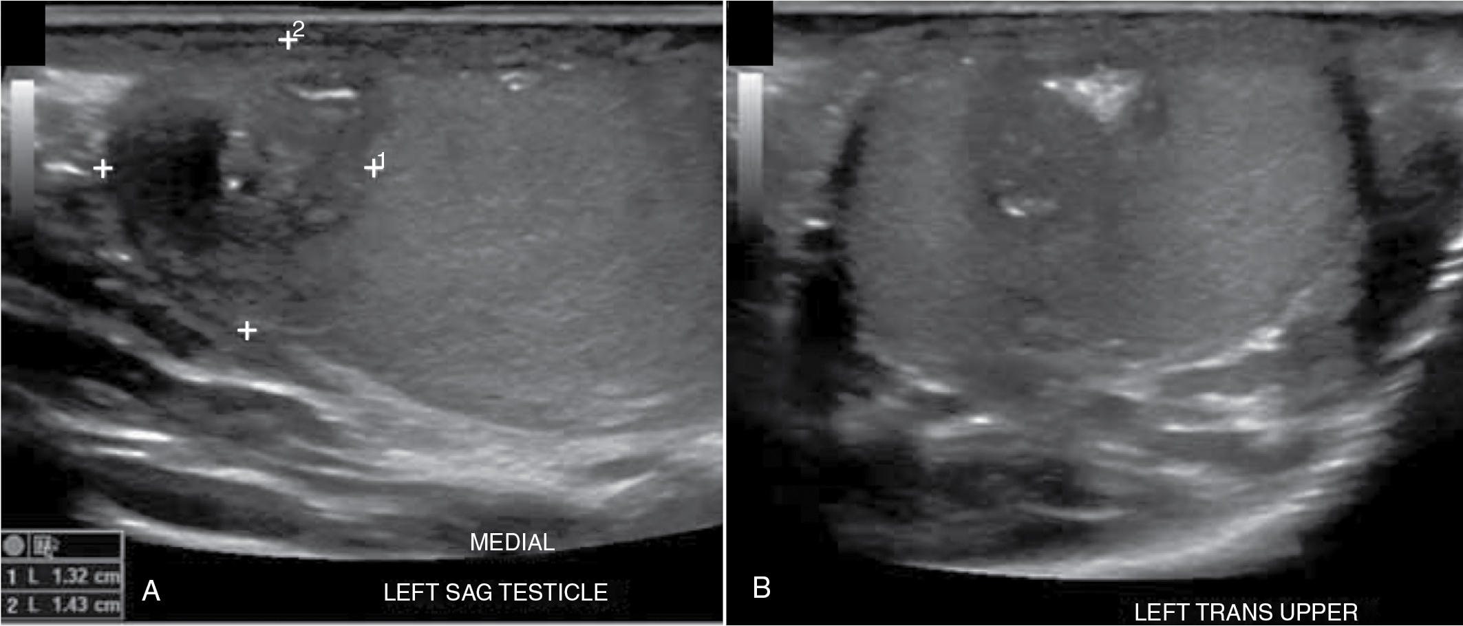 Fig. 30.4, Testicular teratoma. Gray-scale ultrasound shows a heterogeneous mass with irregular margins in the upper pole of the left testis (sagittal view measuring 1.32 × 1.43 cm) (A); the transverse view shows internal macrocalcification. Pathology demonstrated a teratoma (B).