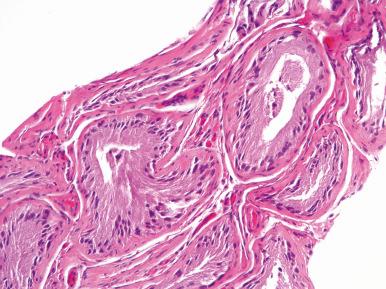 Figure 27.2, Testis biopsy showing Sertoli cell only syndrome.