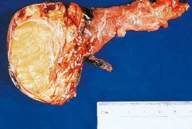 Figure 27.4, Gross Appearance of Granulomatous Orchitis.