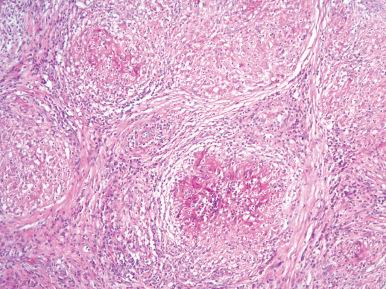 Figure 27.5, Microscopic appearance of granulomatous orchitis associated with tuberculosis.
