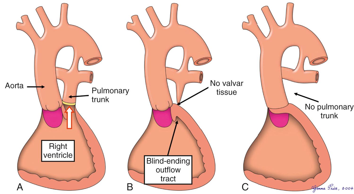 Fig. 36.1, Varying arrangements at the pulmonary ventriculoarterial junction that underscore the phenotypic cardiac variants in the setting of tetralogy with pulmonary atresia. There is further variability with regard to the morphology of the ventricular septal defect.