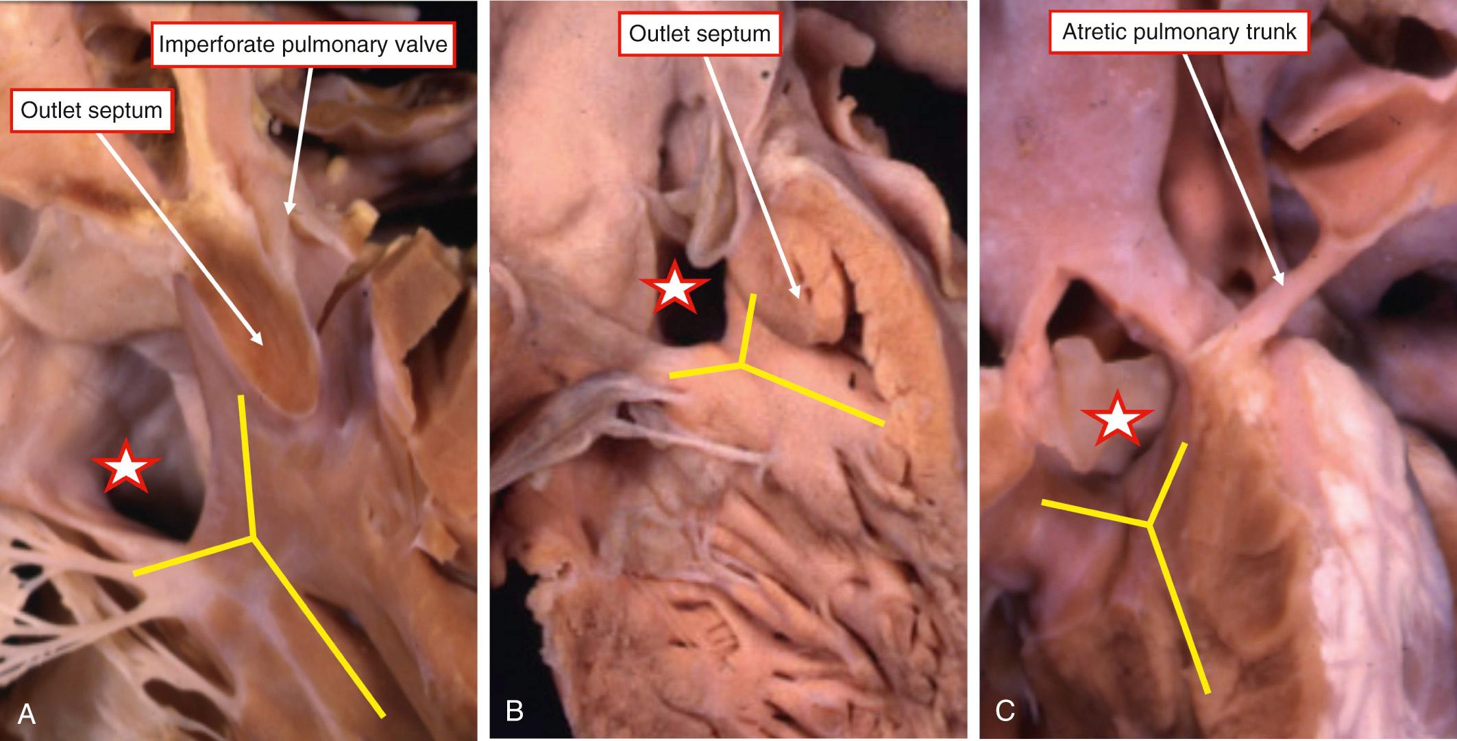 Fig. 36.2, Varying intracardiac morphology to be found in the setting of tetralogy of Fallot with pulmonary atresia. (A–B) In these hearts the muscular outlet septum is attached to the cranial limb of the septomarginal trabeculation (yellow bars) . The pulmonary valve is imperforate in (A), whereas the atresia is muscular in (B). (C) Heart with an atretic pulmonary trunk but no evidence of formation of the subpulmonary infundibulum. The ventricular septal defect (star) is perimembranous in (A), has a muscular posteroinferior rim in (B), and is doubly committed and juxta-arterial in (C).