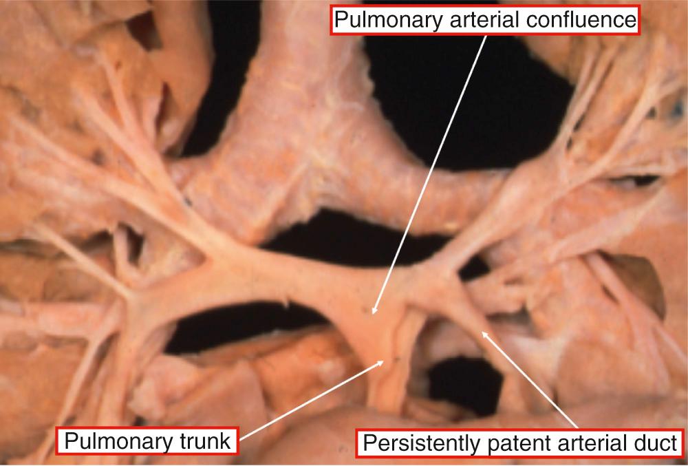 Fig. 36.3, Unifocal pulmonary arterial supply through confluent pulmonary arteries fed by a persistently patent arterial duct. The aorta has been turned forward and the base of the heart is photographed from the front.