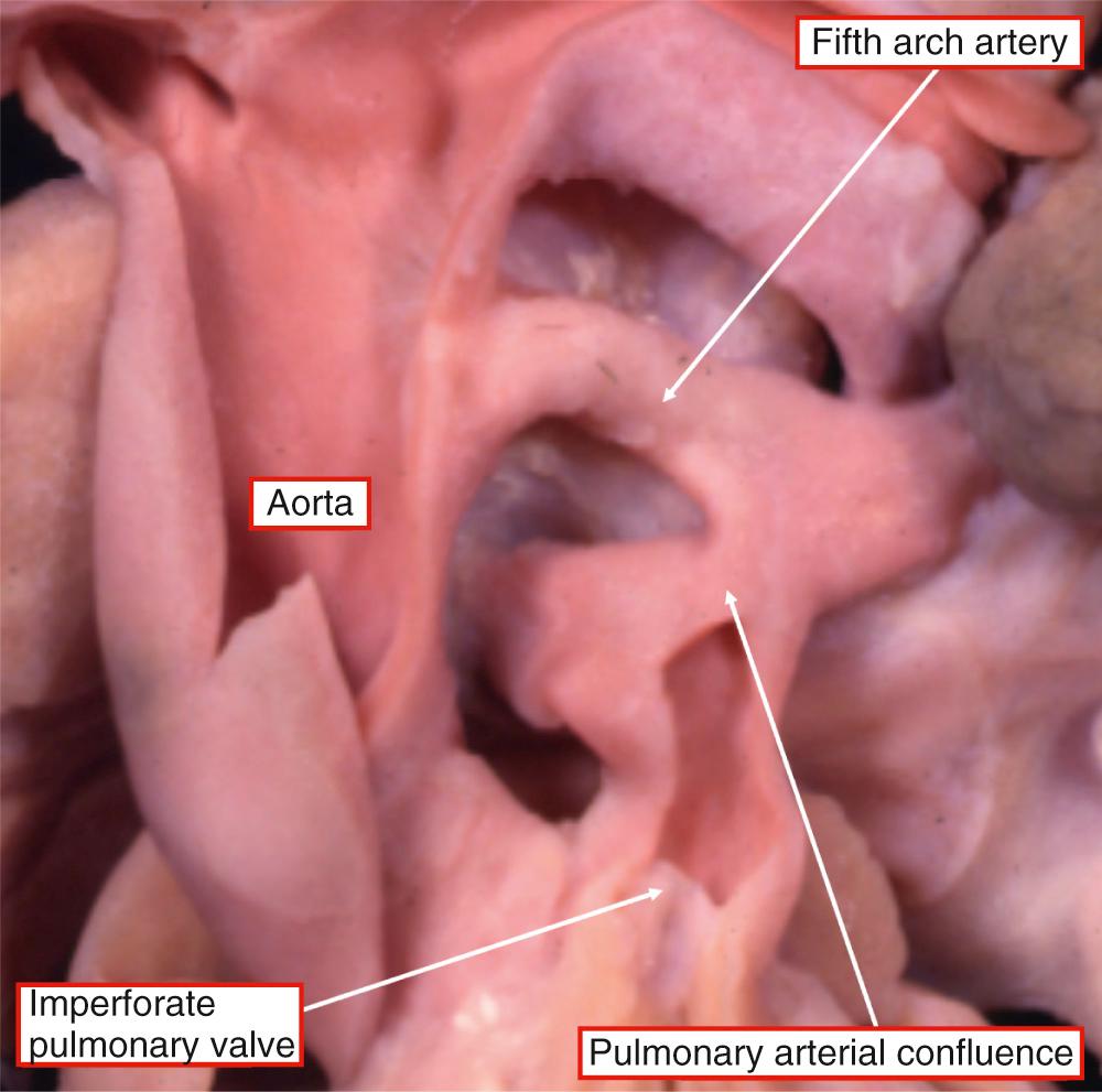 Fig. 36.4, Confluent pulmonary arteries are fed by a channel arising extrapericardially from the ascending aorta just distal to the margins of the pericardial cavity. This channel is likely a persisting artery of the fifth pharyngeal arch.